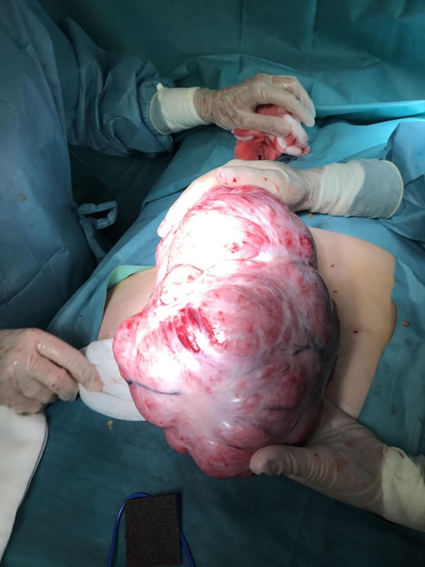 Fibroid removed by laparotomy
